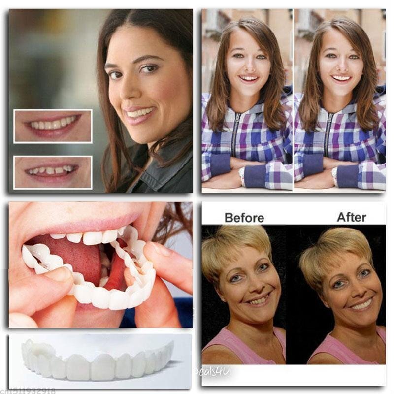 SnapDentures | Schnappzahnersatz