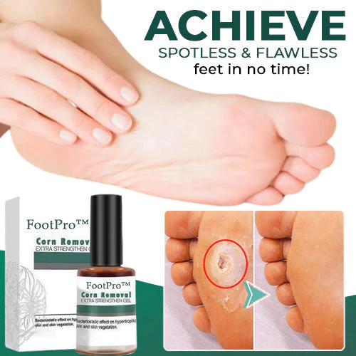 FootPro™ | Hühneraugen Entferner Gel – Schmerzfreies, schnelles und effektives Gel zur sanften Fußpflege und Hornhautentfernung
