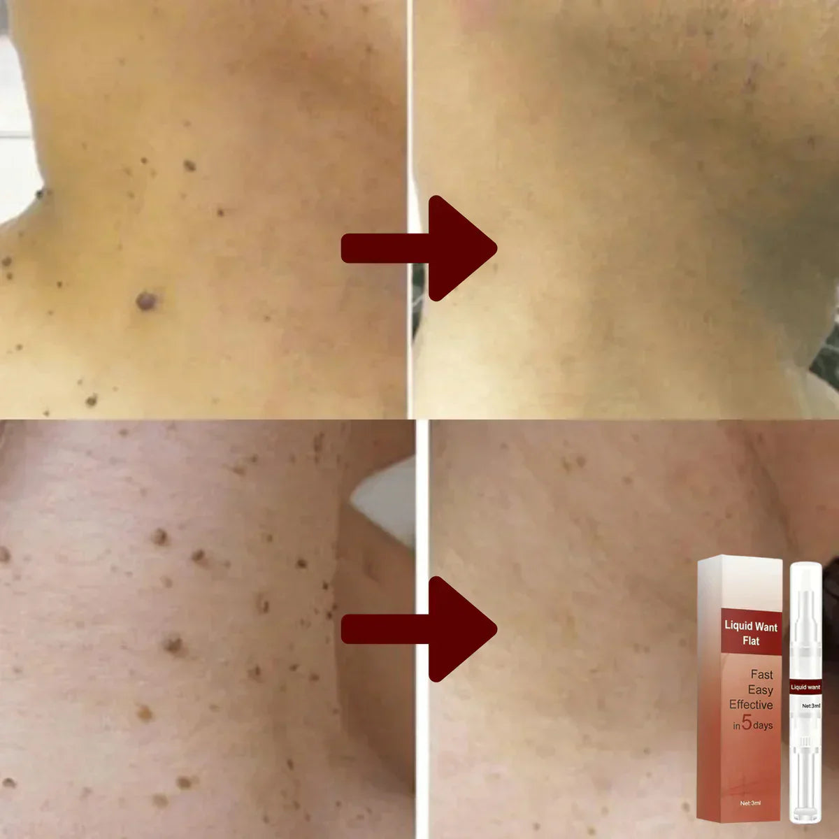 1+1 Gratis |  SkinEase™ | Hartnäckige Flecken und Warzen entfernen