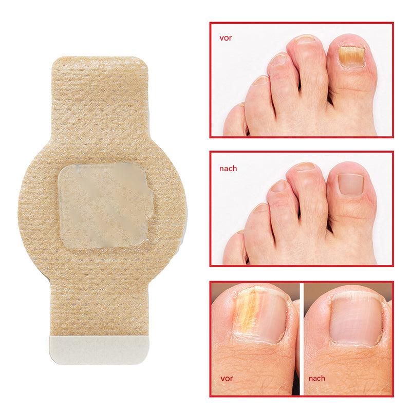 1+1 Gratis | Nailox™ | Klare, gesunde Nägel mit diskreter Pflege den ganzen Tag lang